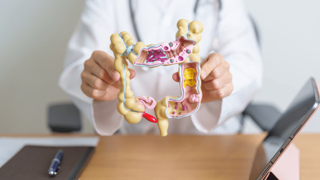 Doctor holding a 3D model of the colon, illustrating diverticulosis and diverticulitis conditions for digestive health education.