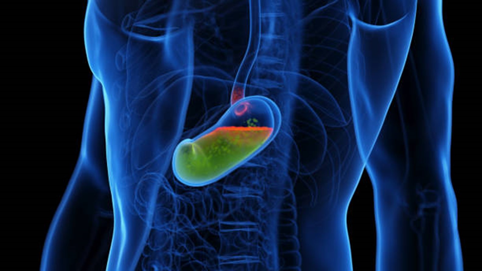 Digital illustration of acid reflux in the esophagus, highlighting gastroesophageal reflux disease (GERD) and its impact on the digestive system.