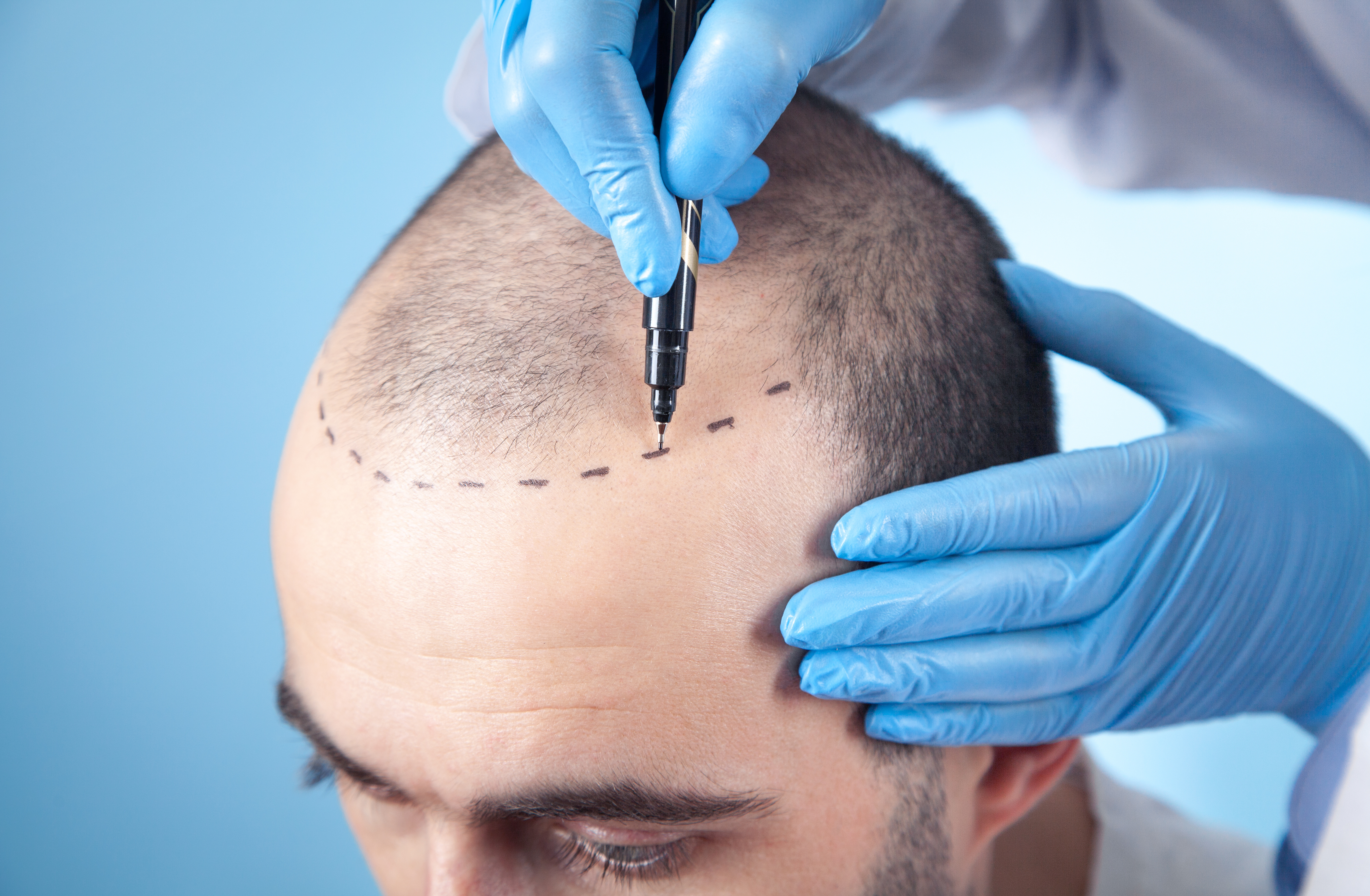 man getting hair restoration