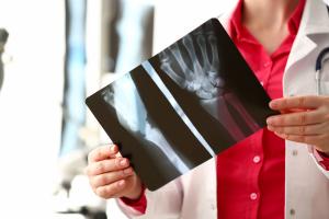 X-ray of a hairline fracture in a person's hand