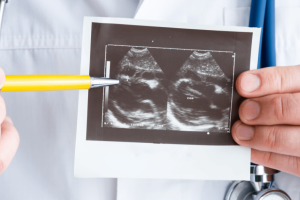 Close-up photo of Summit Health cardiologist holding an ultrasound printout with a pen pointing at signs of pericarditis