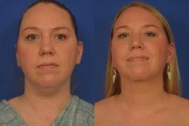 Chin liposuction