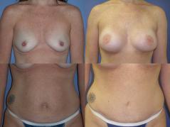 TRAM flap breast reconstruction