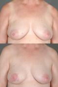 TRAM Flap Breast Reconstruction