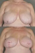 TRAM flap breast reconstruction