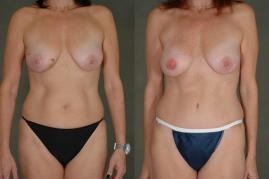 TRAM flap breast reconstruction