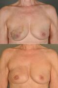 TRAM flap breast reconstruction