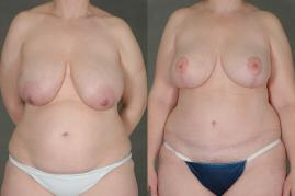 TRAM flap breast reconstruction