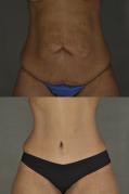 Tummy tuck and arm lift