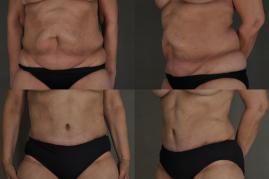 Tummy tuck and liposuction