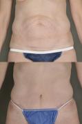 Tummy tuck