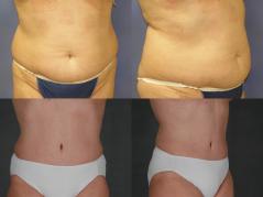 Tummy tuck