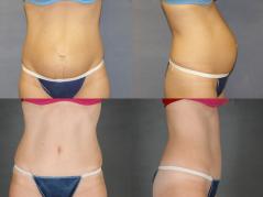 Tummy tuck