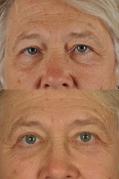 Upper and lower blepharoplasty