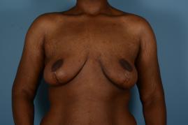 After: Breast Lift