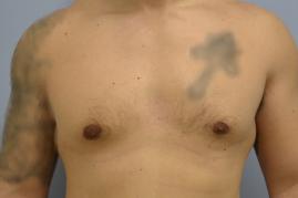 Before (top pic), After (bottom pic): Gynecomastia