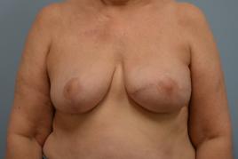 Left Tissue Expander Reconstruction, Right breast reduction