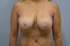 Bilateral Breast Reconstruction