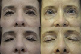 Before- left photos,  After- right photos: Blepharoplasty (upper only)