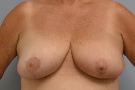 Left oncoplastic breast reduction, Right breast reduction for symmetry