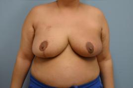 left onco breast reduction and right breast reduction for symmetry