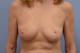 Right breast oncoplastic reduction, Left breast reduction for symmetry