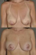 breast-lift-and-augmentation-p3.jpg