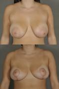 breast-lift-p4.jpg