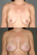 breast-reconstruction-and-tissue-expanders-lip-p20_lMKSrod.jpg
