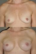 breast-reconstruction-and-tissue-expanders-p4.jpg
