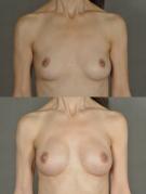 breast-reconstruction-and-tissue-expanders-p45.jpg