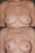 breast-reconstruction-and-tissue-expanders-p46.jpg