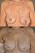 breast-reconstruction-and-tissue-expanders-p47.jpg