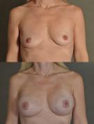 breast-reconstruction-and-tissue-expanders-p50.jpg