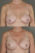 breast-reconstruction-and-tissue-expanders-p52_q5zeoUM.jpg