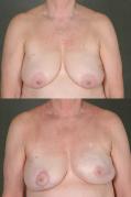 breast-reconstruction-and-tissue-expanders-p53.jpg
