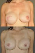 breast-reconstruction-and-tissue-expanders-p55.jpg