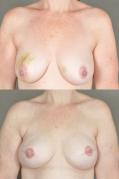 breast-reconstruction-and-tissue-expanders-p56.jpg