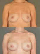 breast-reconstruction-and-tissue-expanders-p57.jpg