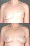 breast-reconstruction-and-tissue-expanders-p58.jpg