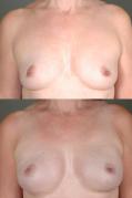 breast-reconstruction-and-tissue-expanders-p59.jpg