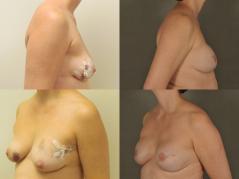breast-reconstruction-with-implants-g1.jpg