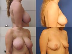 breast-reduction-and-breast-lift-g5.jpg