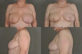 breast-reduction-oncoplastic-reduction-g5.jpg