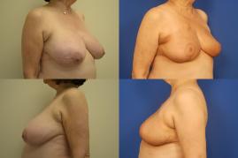 breast-reduction-oncoplastic-reduction-g6.jpg