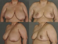 breast-reduction-p12.jpg