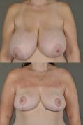breast-reduction-p15.jpg