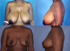 breast-reduction-p17.jpg