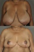 breast-reduction-p2.jpg
