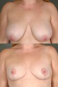 breast-reduction-p22.jpg